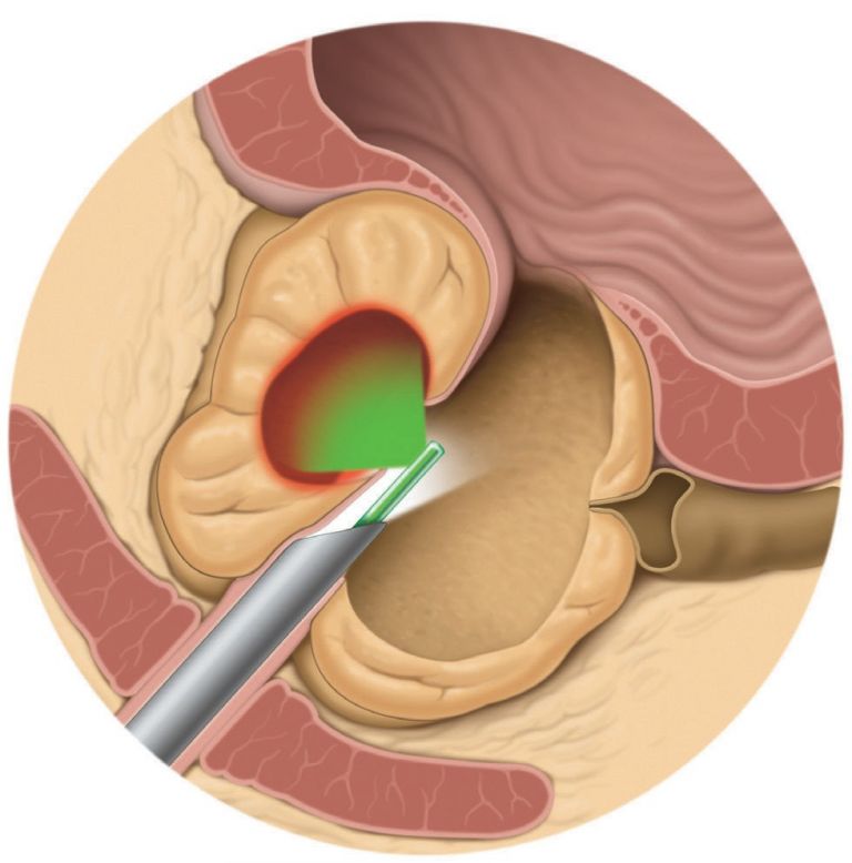 prostata piccola adenomatosa